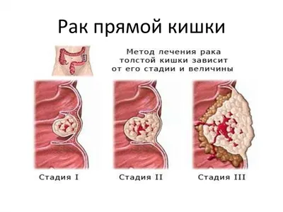 Болезнь Боуэна – внутриэпидермальный... - Bogomolets Clinic | Facebook