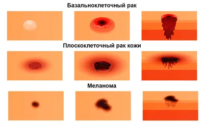 Стоматология доктора Максима Токаренко » РАК ЗУБА: ВИДЫ, ПРИЧИНЫ  ВОЗНИКНОВЕНИЯ, ЛЕЧЕНИЕ