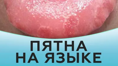 Тонзиллит - причины появления, симптомы заболевания, диагностика и способы  лечения