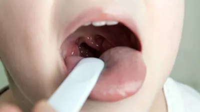 Кандидоз полости рта: симптомы, особенности, диагностика и лечение  заболевания - блог «ДИНАСТИЯ»