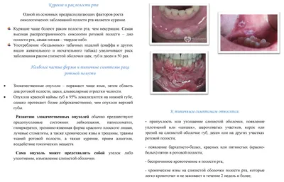 Рак горла – диагностика, лечение, удаление новообразований в Москве