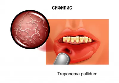 Что такое рак миндалин: стадии развития и факторы риска - Clinics on Call