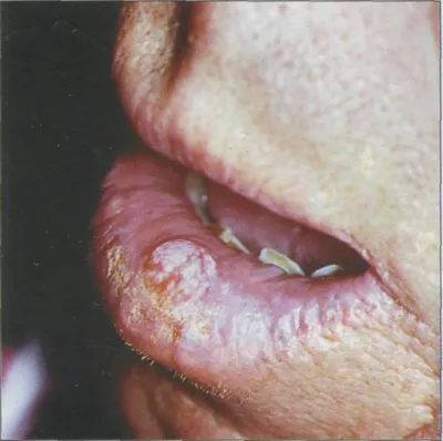 рак нижней губы