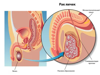 Рак Яичек 3d Иллюстрация — стоковые фотографии и другие картинки Рак яичка  - Рак яичка, Клетка Лейдига, Настороженность - iStock