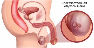 Рак яичка у мужчин: симптомы и причины, классификация, диагностика и  лечение, прогнозы