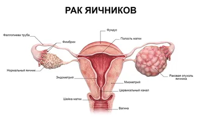 Рак яичников лечение в Индии по самой низкой цене