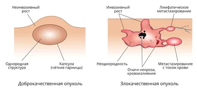 Как быстро развивается рак яичников?