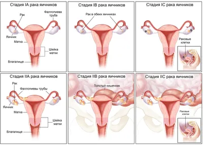 Рак яичников: лечение в Беларуси | БелМедТуризм