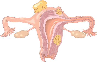 Профилактика рака яичников | «Университетский Медицинский Центр»