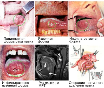 Рак языка | Пикабу