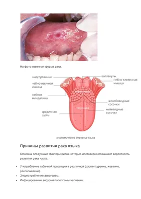 Злокачественные опухоли полости рта — Википедия