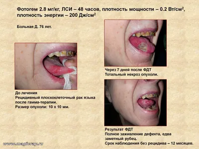 Глоссит | Стоматология Бескудниково