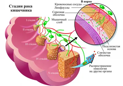 Рак толстой кишки - БУ \"Нижневартовский кожно-венерологический диспанс