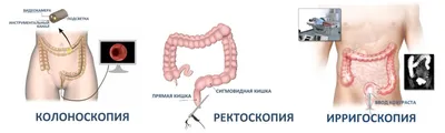 БУЗ Ижевская городская поликлиника №2 - Профилактика рака толстого кишечника