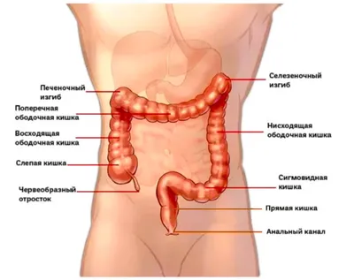 Рак ободочной кишки - симптомы и лечение