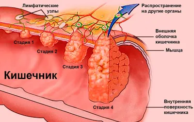 Колоректальный рак (рак толстой кишки): описание, методы диагностики и  лечение болезни. Онкология