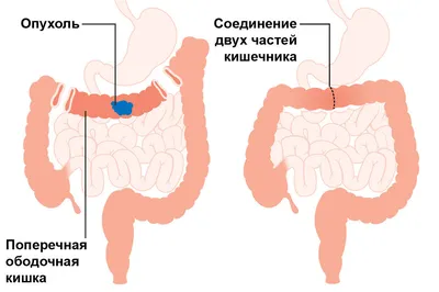 Скрининг рака кишечника в Centrālā laboratorija