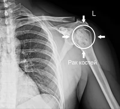 Ученые разработали метод лечения рака костей, который не требует ампутации  или химиотерапии - EcoPravda.ru