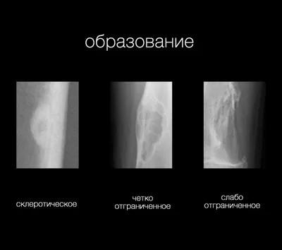 Череп пациента, который скончался от опухоли кости | Пикабу