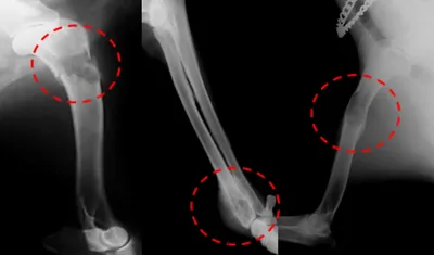 Думал стоматит — оказалось, рак 4 стадии: врачи сделали челюсть челябинцу  из кости ноги
