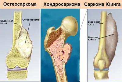 Рентгенография Показала Метастазы Рака Таза Кости Бедренной Кости стоковое  фото ©Richmanphoto 664386484