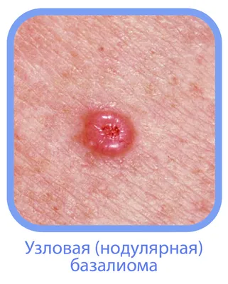 В России разработали способ эффективной ранней диагностики рака кожи