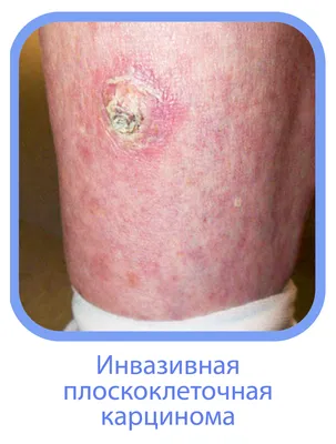 Рак кожи: признаки, диагностика, лечение — УЦМС «Лезар»