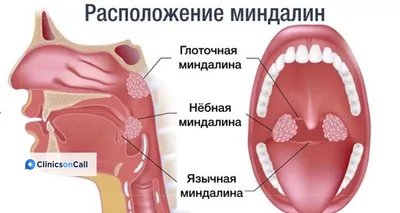 Рак миндалин фото