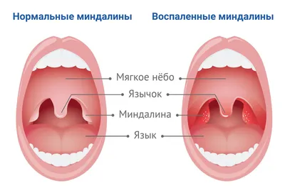 Рак миндалин (опухоль гланд) - симптомы, причины, диагностика и лечение в  лучших клиниках