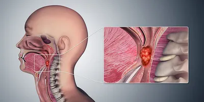 Рак горла / Здоровье