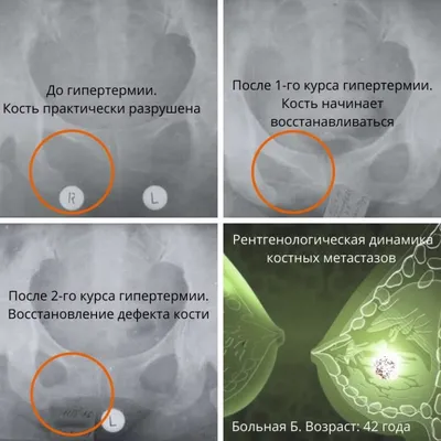 Комплекс реконструктивных операций помог пациентке восстановить форму  груди, которая была утрачена в связи с наличием ракового