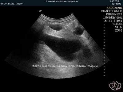 Лечение рака молочной железы на 1, 2, 3 и 4 стадиях развития болезни