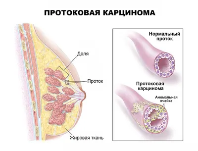 Лечение рака молочной железы в России. Подробная информация