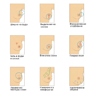 РАК МОЛОЧНОЙ ЖЕЛЕЗЫ: как проверить симптомы? — Доказательная Медицина на  TenChat.ru