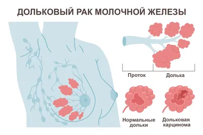 Маммография при раке молочной железы и для профилактики.