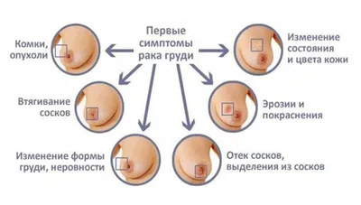 Дольковый рак молочной железы: симптомы, причины, лечение, прогноз