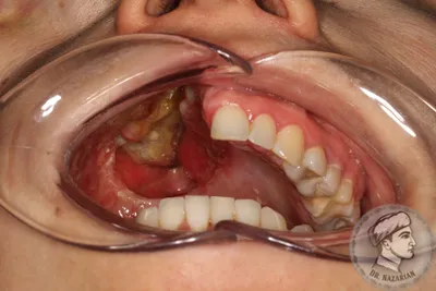 Рак полости рта: фото начальной стадии, симптомы, лечение и прогноз -  Belhope.ru