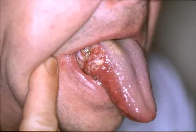 Рак полости рта: вовремя распознать и вылечить! | Городская поликлиника 4