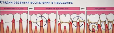 Доброкачественные опухоли полости рта: что провоцирует, виды, лечение