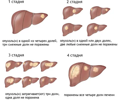 Рак печени