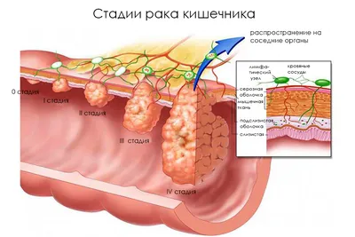 Метастазы при раке молочной железы - методики лечения 2023