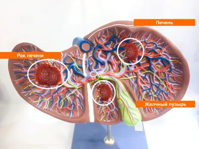 Как выглядит рак печени — Онкохирургическое отделенеие №2