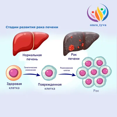 Рак печени лечение: прогноз, лечение, симптомы в международной клинике  Медика24