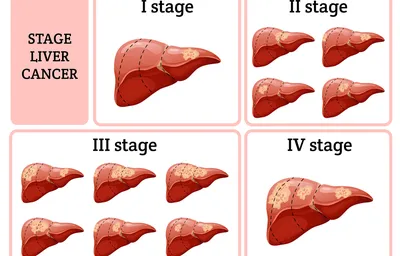 Рак печени: факторы риска, диагностика, лечение