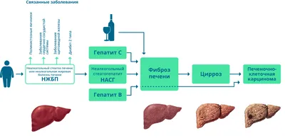 Рак печени: симптомы, лечение - YarNews.net