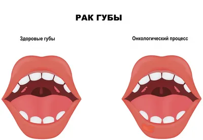 Кандидоз полости рта: симптомы, особенности, диагностика и лечение  заболевания - блог «ДИНАСТИЯ»