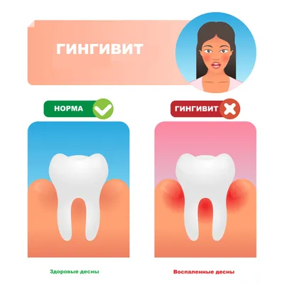 Стоматит: лечение, симптомы, виды, признаки у взрослых и детей