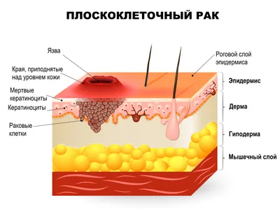 Рак горла – диагностика, лечение, удаление новообразований в Москве