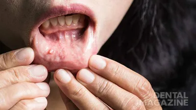 Из-за пандемии может возрасти смертность от рака полости рта -  DENTALMAGAZINE.RU