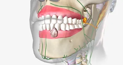 Ранняя диагностика раковых образований в полости рта может спасти жизнь.  Кейс от Articon | ARTICON цифровая стоматология в Москве | Дзен